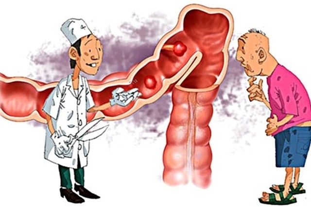 viêm đại tràng mãn tính